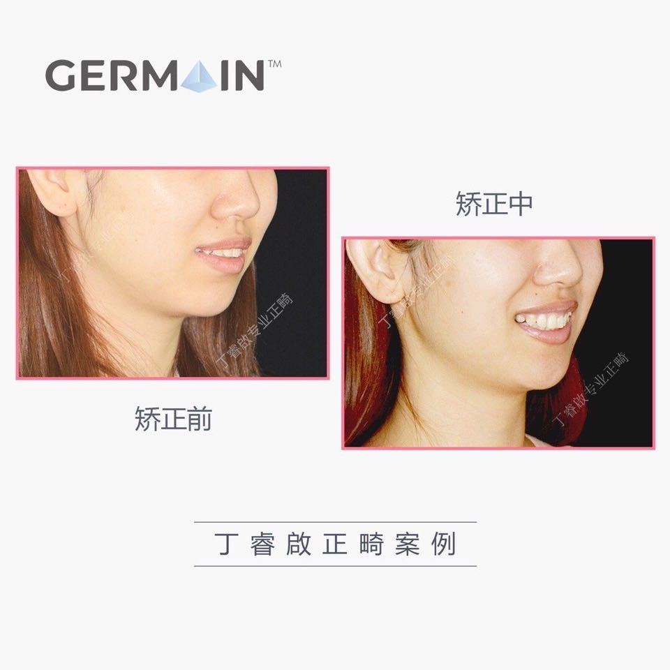 郑州牙齿矫正丁睿啟｜下巴后缩病例合集