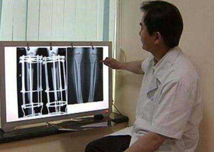 断骨长高李亚诺现状,中国断骨增高第一人李亚诺