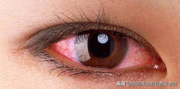 戴隐形眼镜后眼睛发红，谨慎可能是角膜炎