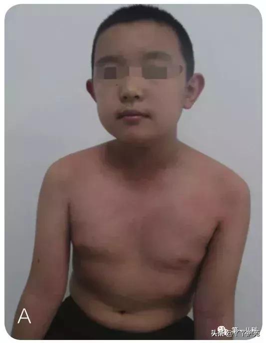 麻疹水痘猩红热手足口病区别,猩红热手足口病怎么治