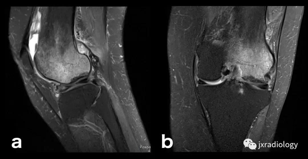 磁共振骶髂关节骨髓水肿是强直吗,磁共振显示骨髓水肿什么意思