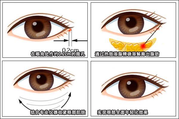 眼袋过大是什么原因怎么办,请问眼袋大是什么引起的怎么治疗