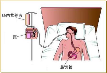 食道癌吞咽困难怎样改善,食道癌吞咽困难的妙方中医