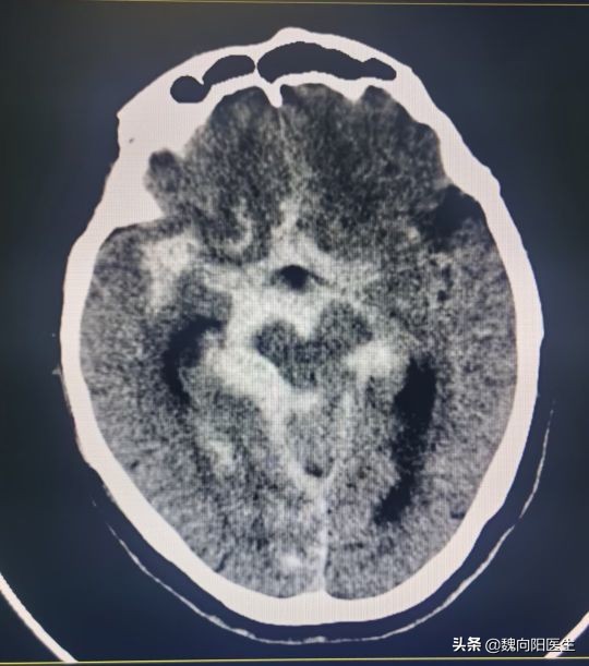 脑子里突然炸了一下,腰上有淤血要不要放血