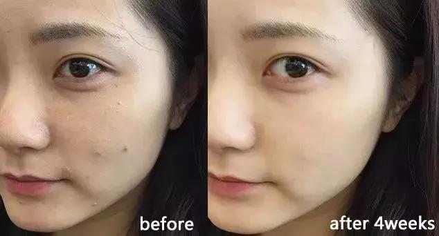 蜂胶消炎祛痘,蜂胶治疗皮癣吗