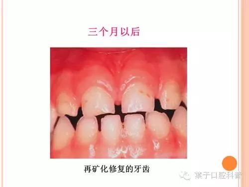 吃什么食物可以预防和修复蛀牙,孩子预防蛀牙新方法也太奇葩了