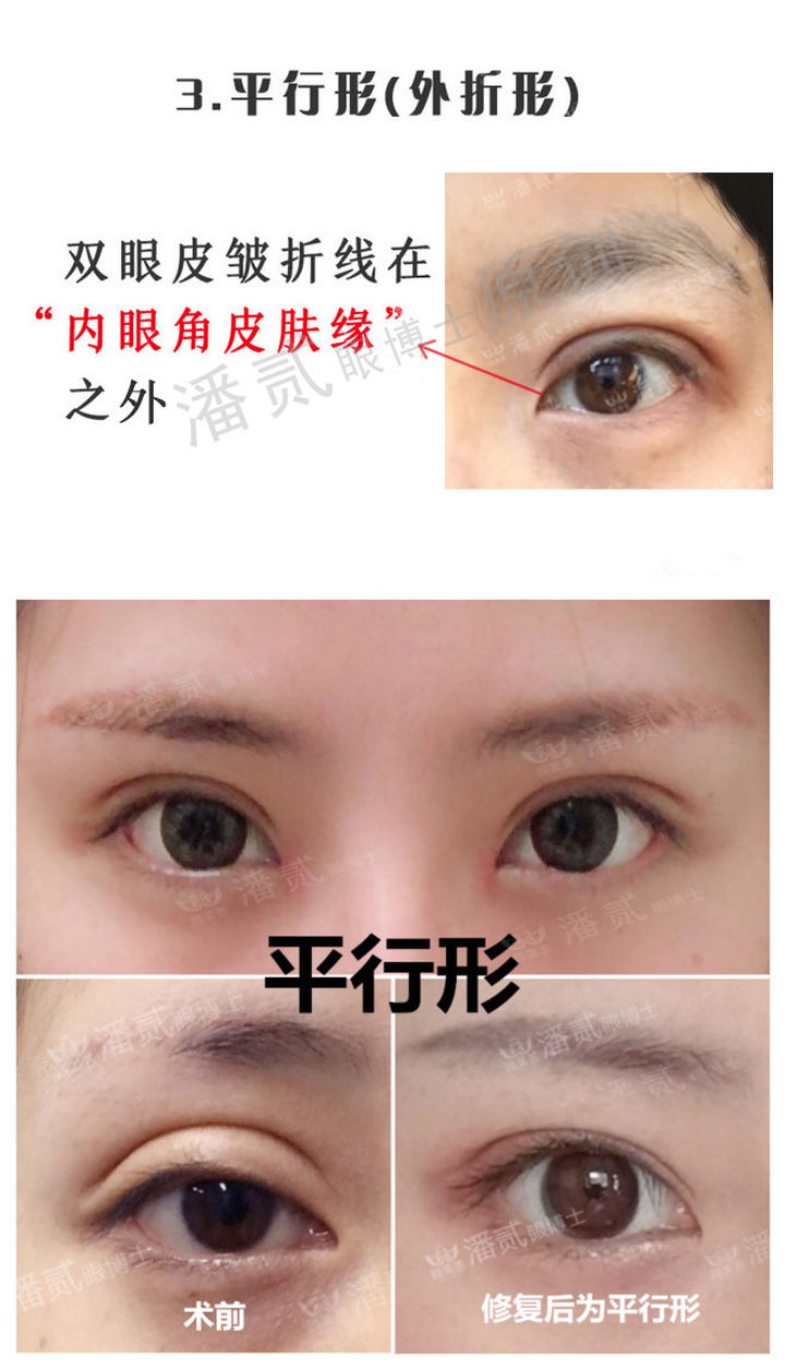 开眼角手术如何避免回缩,开眼角手术常见问题及解决方法