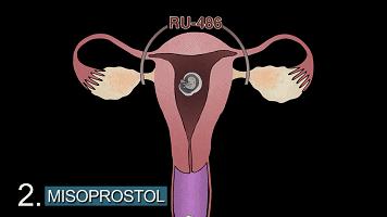 为什么那么多人避孕失败,避孕失败的女生