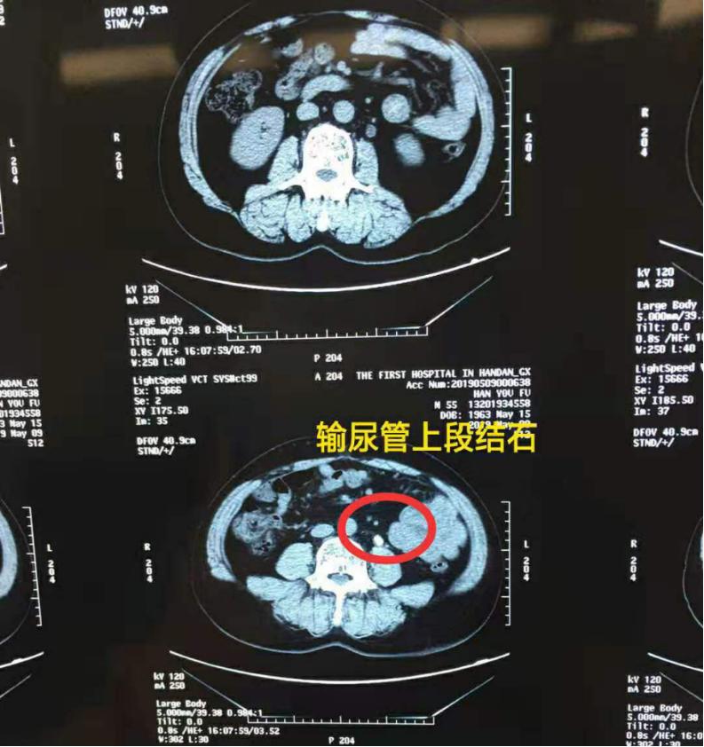 尿路结石有哪几种手术可以做,尿路结石手术是大手术么