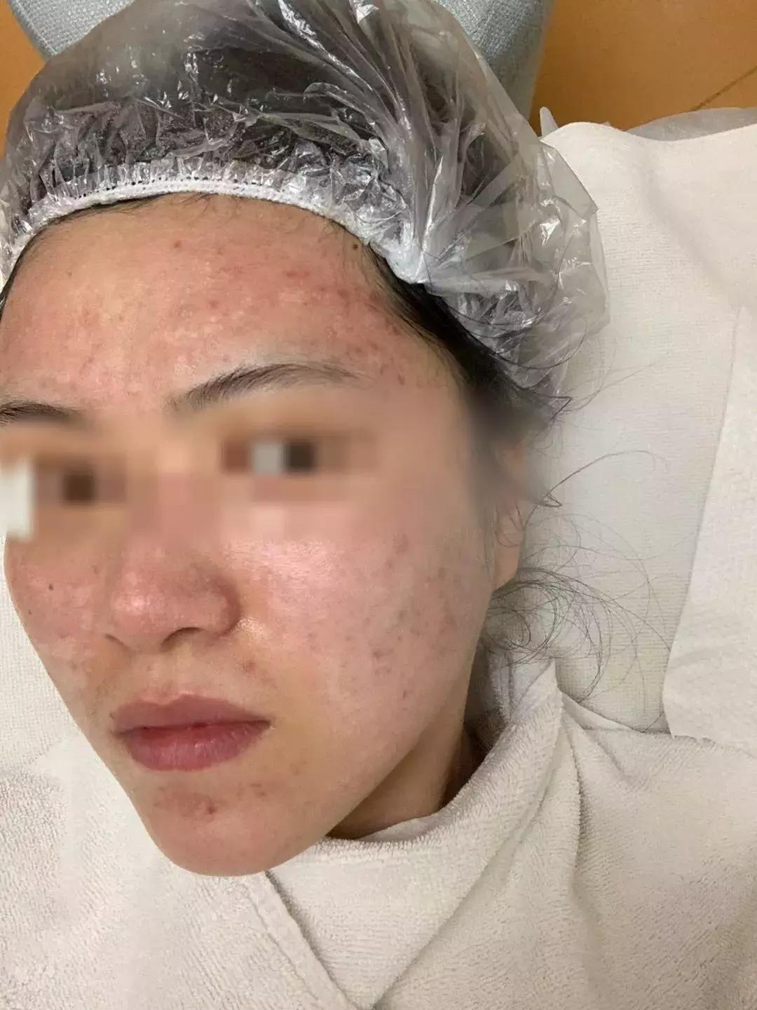 一次美容后她脸烂了！无锡这位女士在整形医院经历了什么……