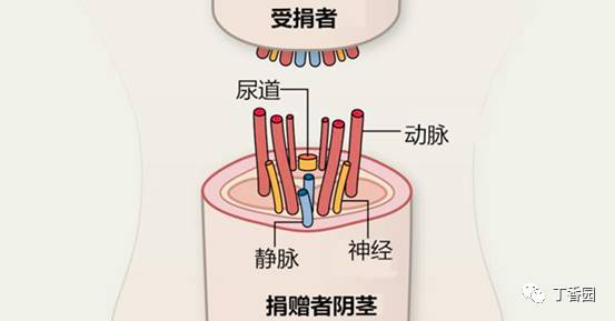 五年前那个接受了阴茎移植的男子，现在怎么样了？