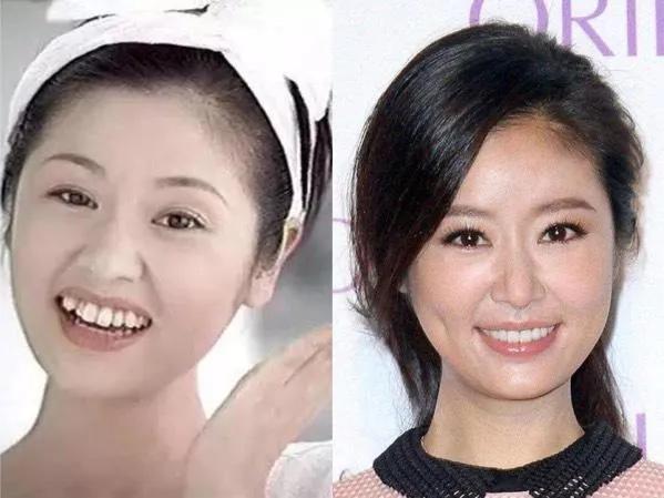 明星整牙前后对比,龅牙明星整牙前后的惊人变化