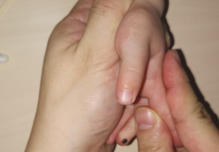 漂浮拇：成功保五指|案例5《左手多指右手漂浮拇，拇指成功搬家》