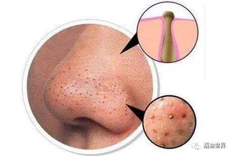 改善黑头的小tips,改善黑头的精华