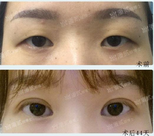 全切双眼皮提肌失败还能修复吗,什么是失败的双眼皮