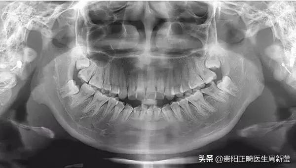 牙齿开瓶盖是嫌它太硬吗？牙齿使用说明书，简直太绝了