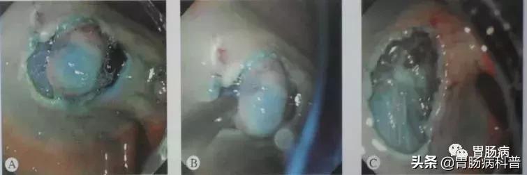 内镜下粘膜剥离术属于esd还是emr,胃肠息肉内镜下黏膜剥离术