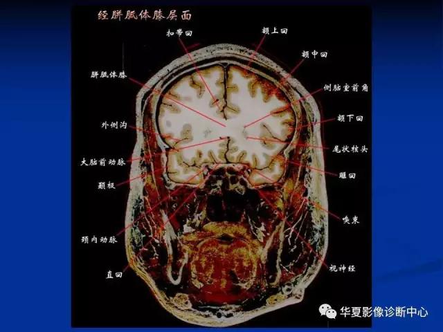 mra头颅解剖学详细讲解视频,常见的头颅mri图像