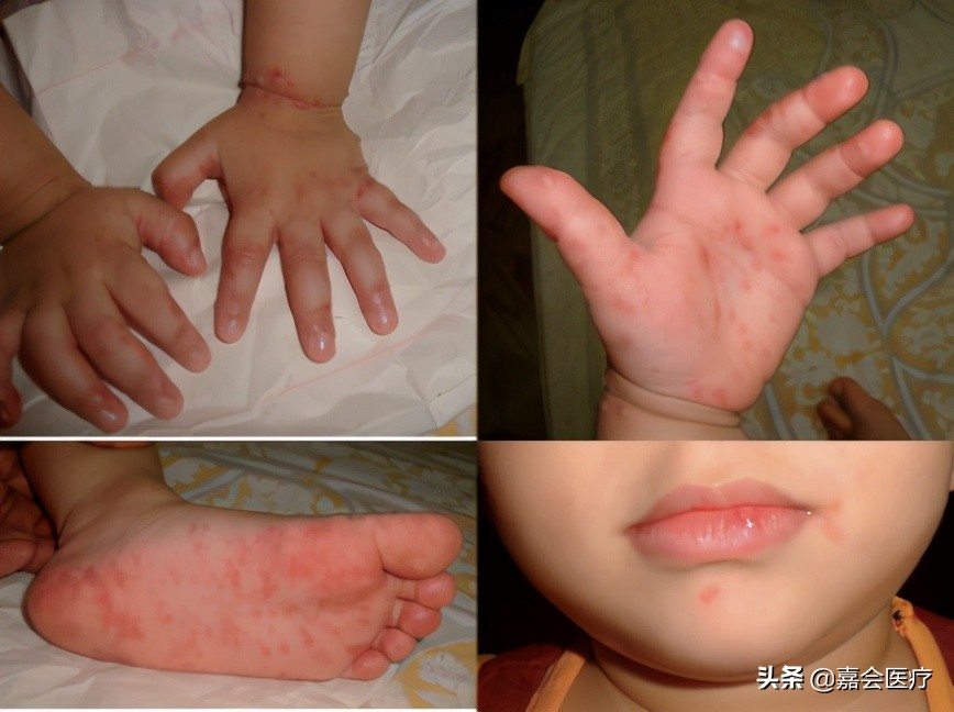 手足口病诊疗指南及解读,手足口病知识普及