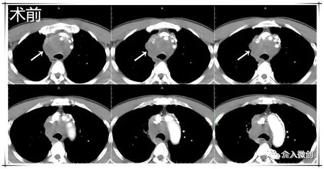 肺神经内分泌癌早期手术好吗,肺部神经内分泌肿瘤治疗
