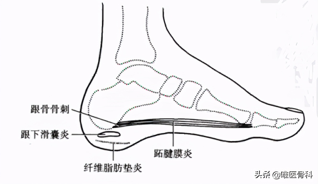 40-60岁脚后跟疼吃什么药,40-60岁脚后跟疼有啥办法