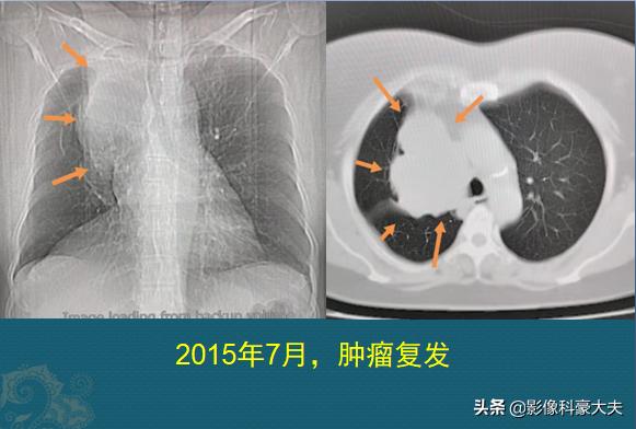 22岁查出癌症放弃治疗,医生自述得癌症放弃治疗