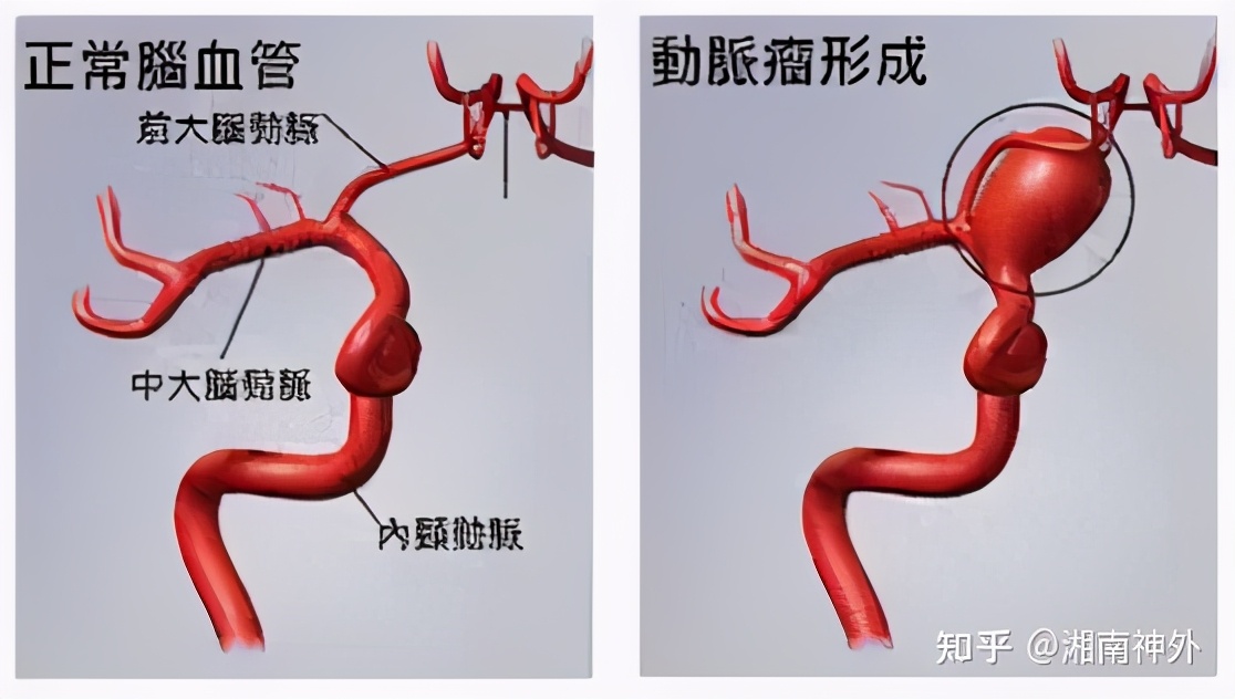 脑动脉瘤的定时炸弹,颅内定时炸弹