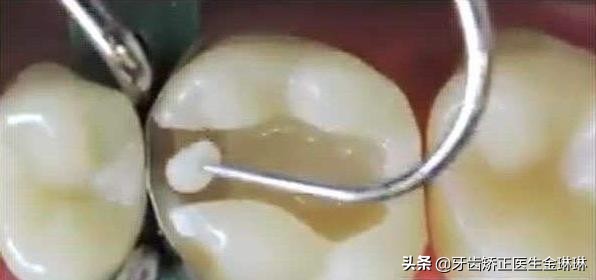 孩子补牙材料老掉怎么回事,所有补牙都需要填充吗