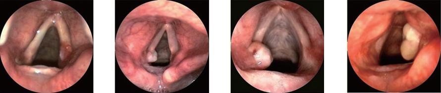 喉接触性肉芽肿的病因,喉接触性肉芽肿中医辨证