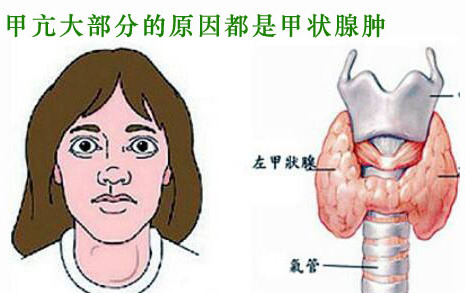 甲亢的健康教育动画视频,甲亢健康教育教学视频