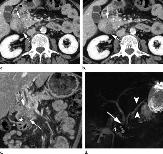 胰腺炎的影像学诊断与鉴别,胰腺炎与胰腺癌的鉴别表格