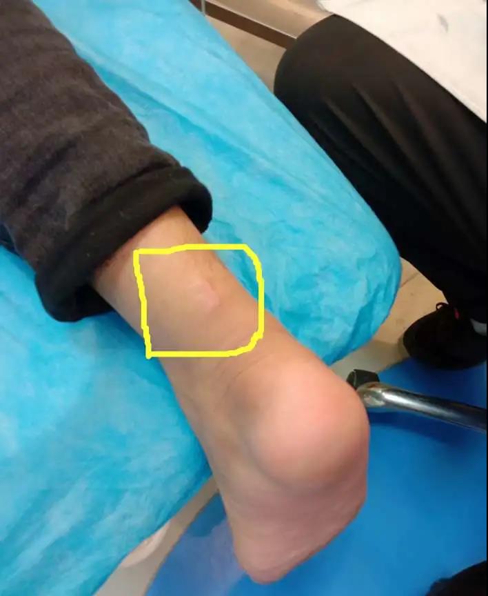 跟腱炎是跟腱断裂的前兆吗,预防跟腱断裂的几个征兆