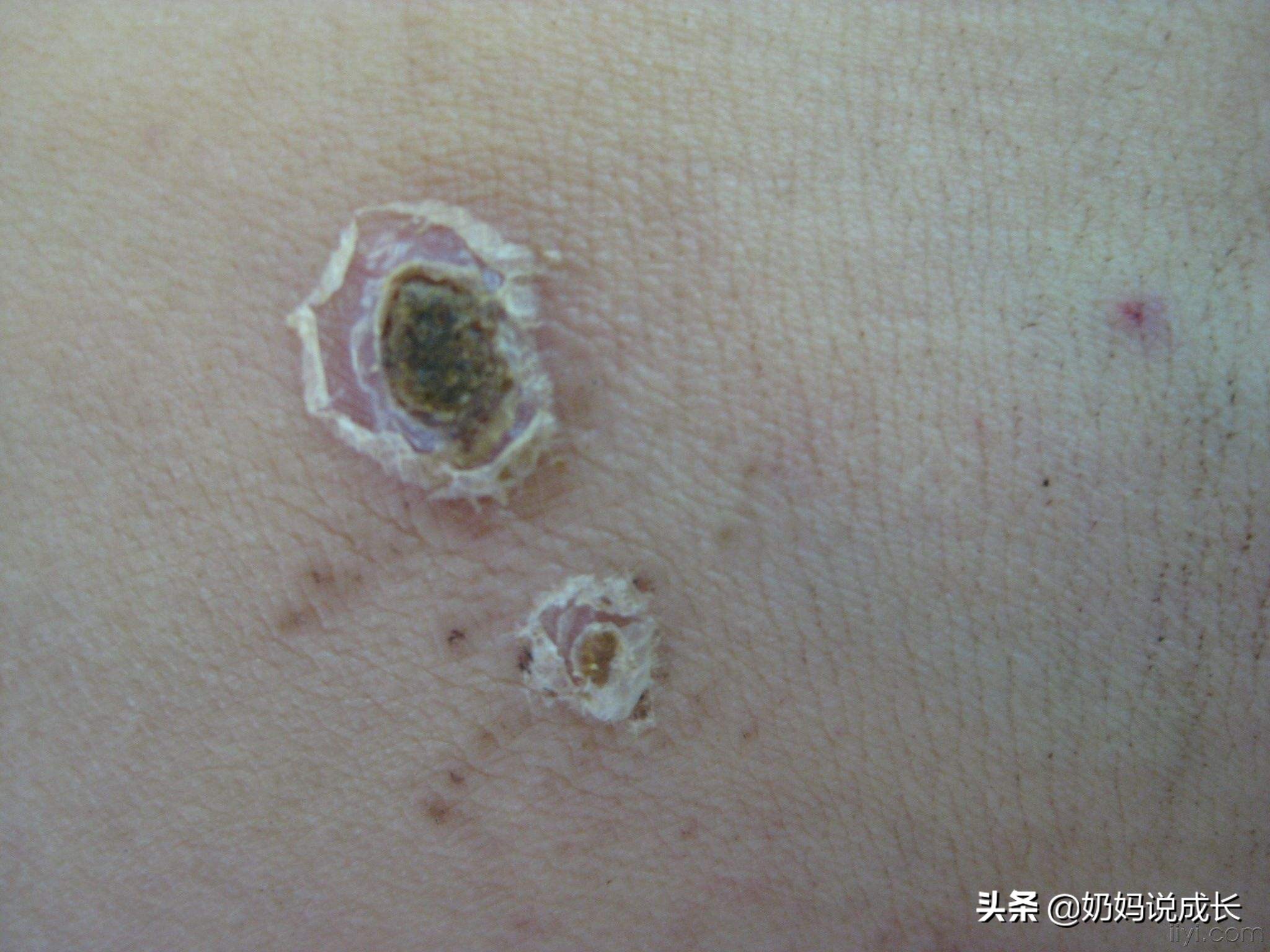 男孩“*处私**被咬”差点危及生命，要命的“*虫病恙**”家长要引起重视