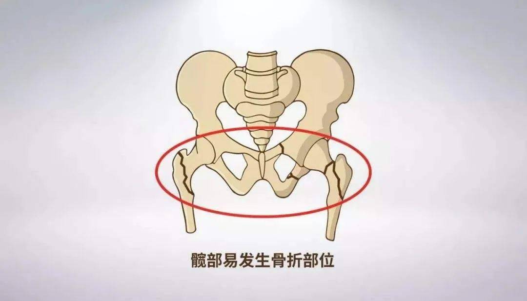 脑梗后遗症摔倒股骨颈骨折,老人脑梗后最后摔倒骨折能活多久