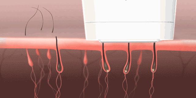 花几千块钱去美容院治痘会好吗,花了数万元购买医美项目