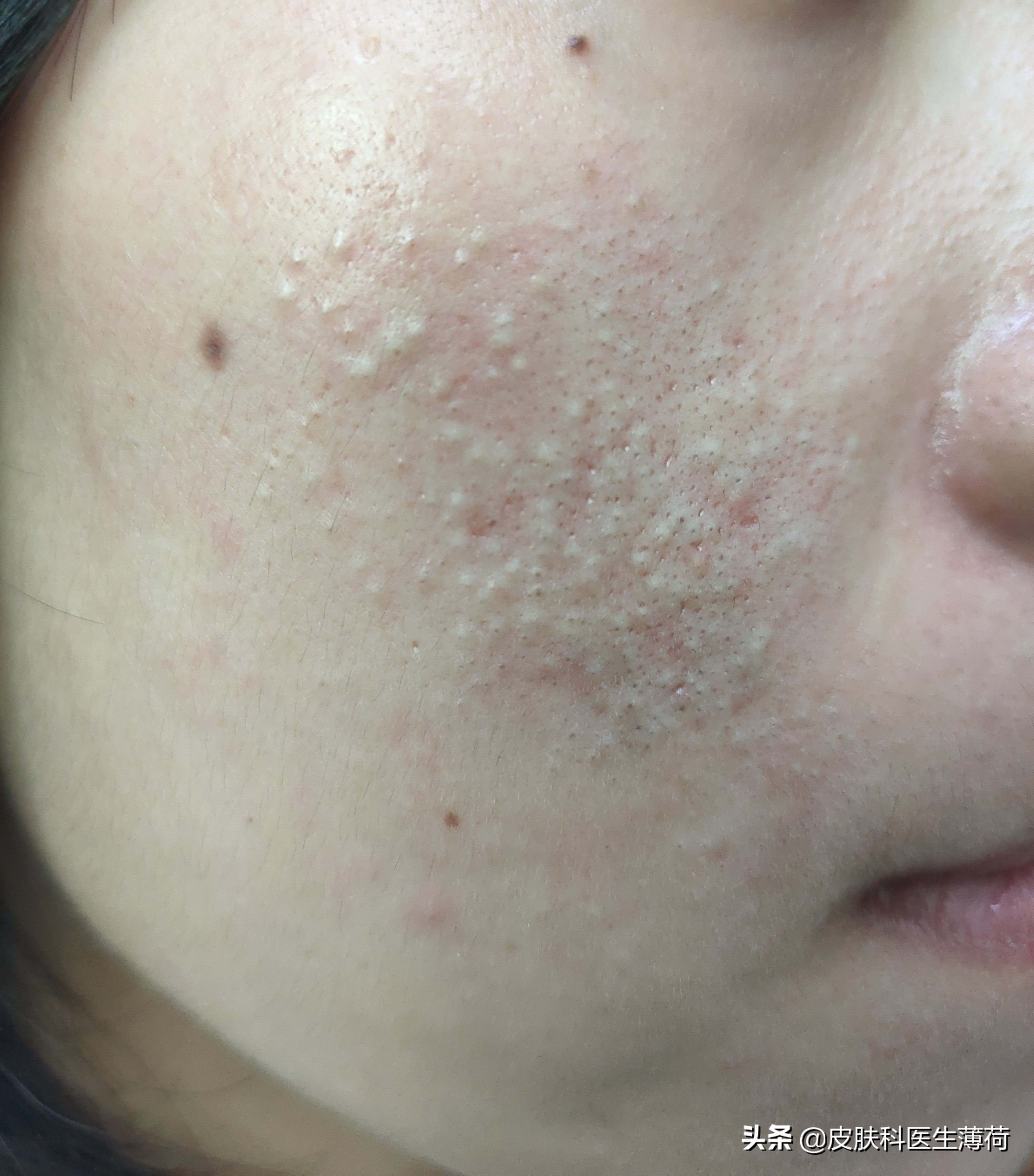 皮肤科医生怎么祛痘痘,皮肤科中医专家教你快速祛痘