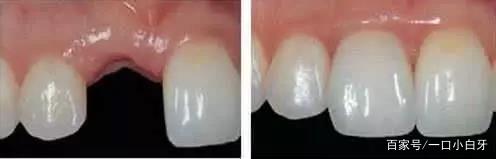 大熊猫戴牙套,大熊猫的牙齿能不能矫正