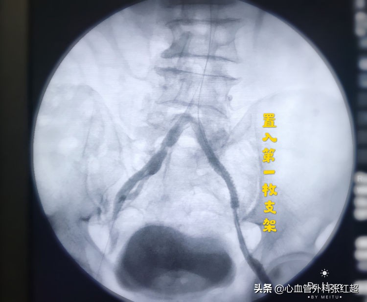 外周血管外科治疗范围,外周血管介入治疗疗程