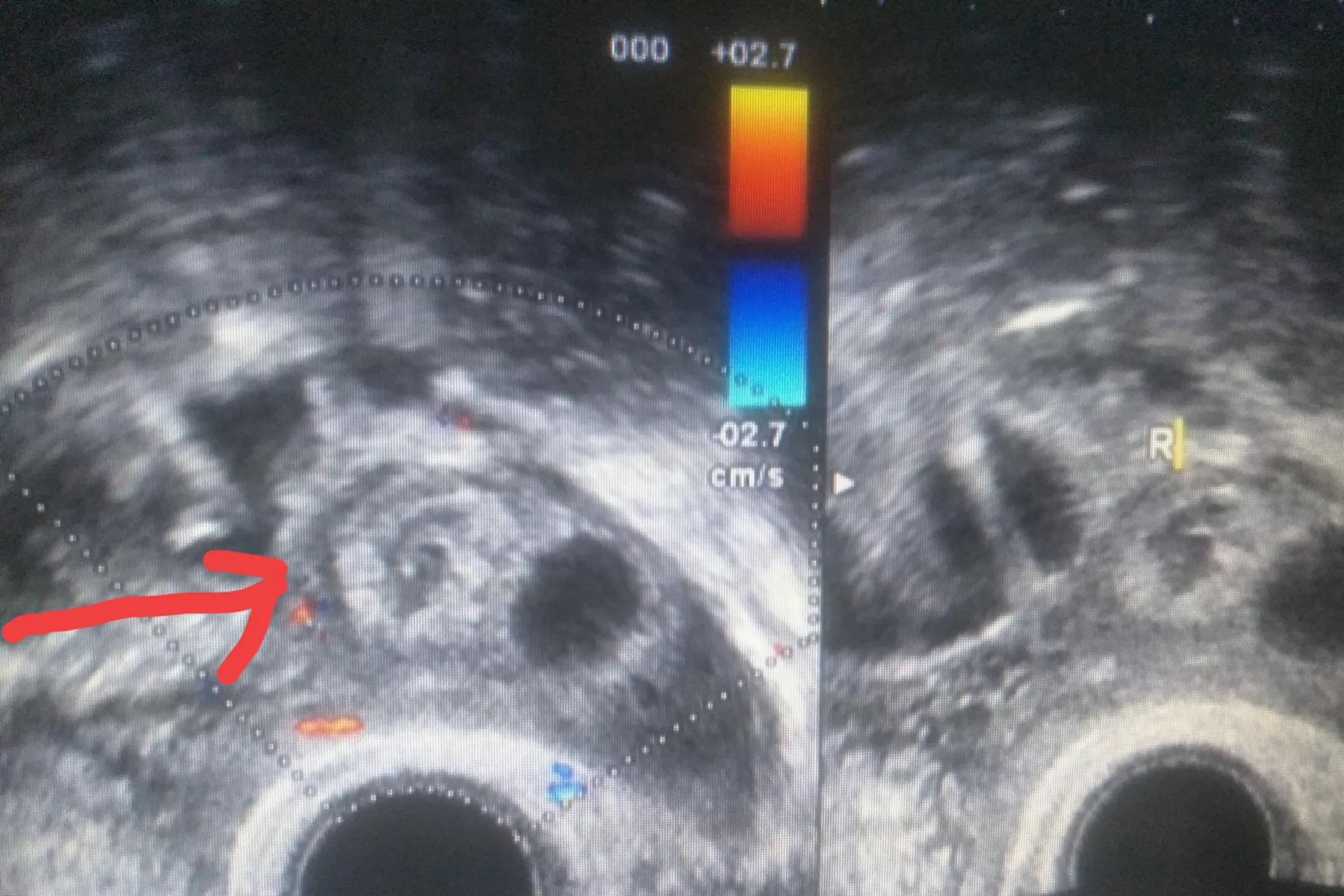 宫外孕开窗术后自然怀孕的有吗,宫外孕术后一个月又怀孕了怎么办