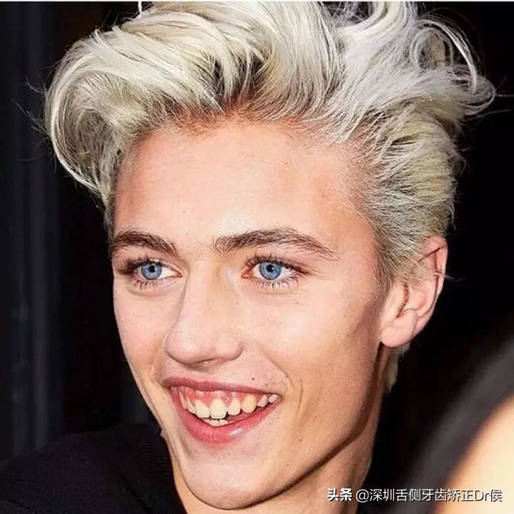 露龈笑原因,露龈笑矫正