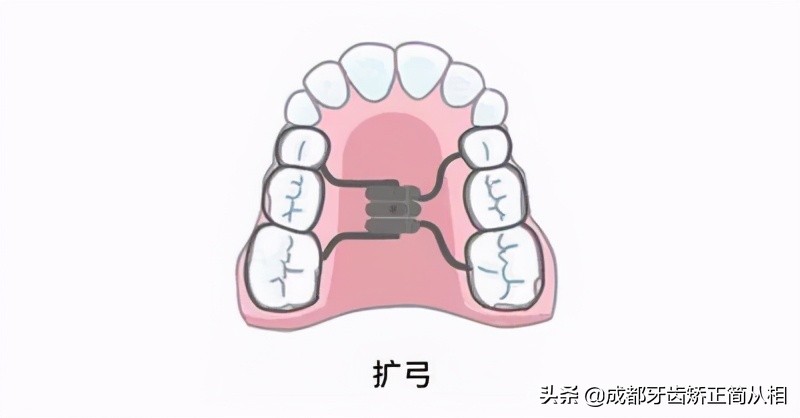 牙齿拥挤怎么矫正最快,下牙牙齿拥挤怎么矫正