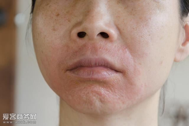 红霉素软膏是痘痘肌女孩的救星哦！一起来看看