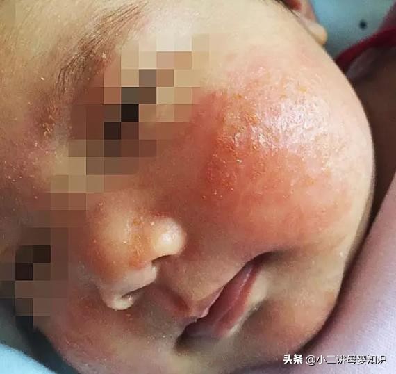 宝宝湿疹的正确防治方法,婴儿湿疹最怕三件事