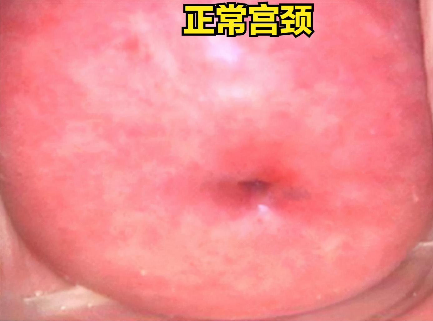 71岁女性筛查hpv高危是不是宫颈癌,男性hpv和哪些癌症有关