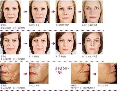 童颜针正确打法,童颜针操作视频教程