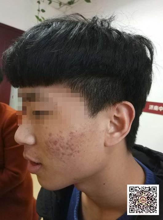 如何去除青春痘的最有效的方法,怎样治疗青春痘最有效的方法