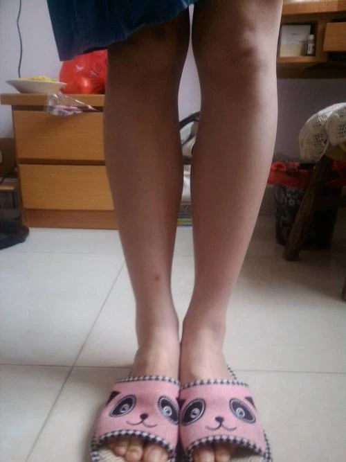 小腿肌肉外翻和膝盖内扣一样吗,小腿肌肉外翻骨头是弯的