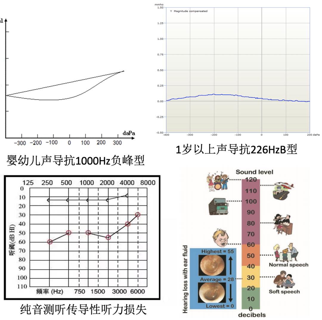 WASS峰会｜针对病因有效治疗，可改善部分儿童的听力损失