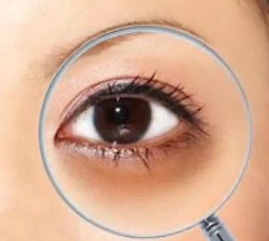 黑眼圈重有细纹怎样遮黑眼圈,有浓厚的黑眼圈该怎么淡化黑眼圈