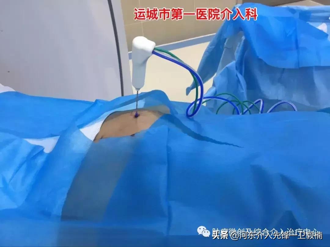 肺癌诊断与微创综合治疗,肺癌晚期的微创介入治疗